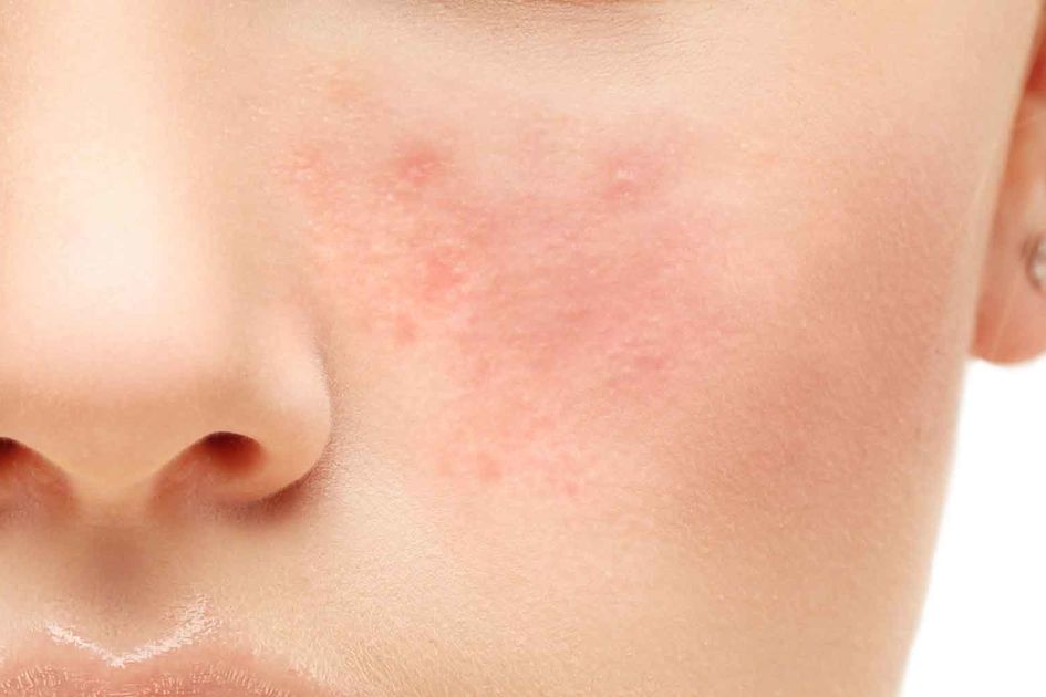 Mengatasi Iritasi Kulit Wajah Merah dan Gatal | Eva Mulia Clinic
